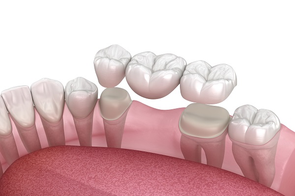 Dental Bridge Options: How Bridges Replace Missing Teeth And Support Bite Function