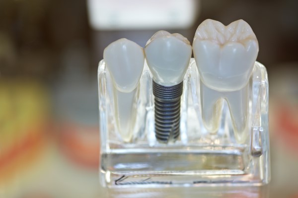 Dental Implants Des Plaines, IL