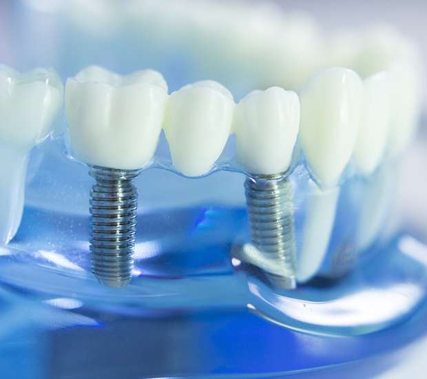 Des Plaines Dental Implants