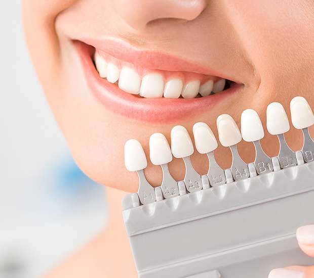 Des Plaines Dental Veneers and Dental Laminates