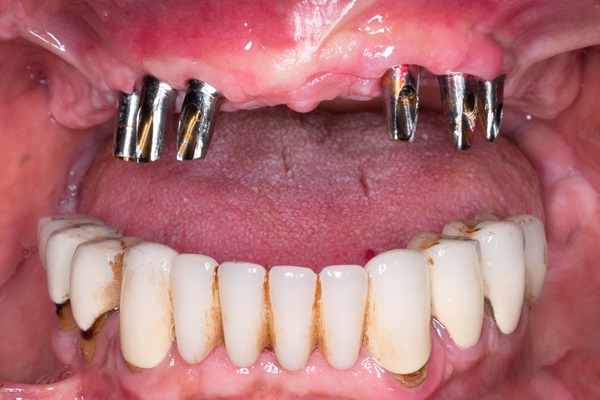 Common Cosmetic Dental Procedures In Full Mouth Reconstruction